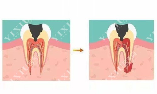 牙髓炎示意图