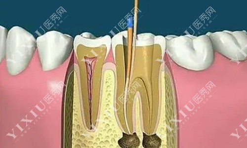 根管治疗示意图