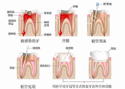 牙齿根管治疗流程卡通图