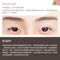 手术难度较大 效果非常好的 厚眼皮手术-眼皮厚的眼睛-韩国原辰整形外科医院