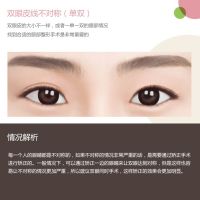 严重双眼皮不对称需要矫正进行变得完美-双眼皮线不对称-韩国原辰整形外科医院