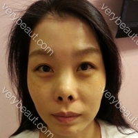 鼻部手术修复_4月31日整形外科整形案例