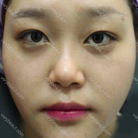 脸上的小色素和肉肉脸！知名的烦恼！溶脂针+激光—韩国童颜中心医院整形案例