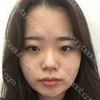 在韩国做了眼综合+鼻综合 颜值爆表说的就是我_DA整形医院整形案例