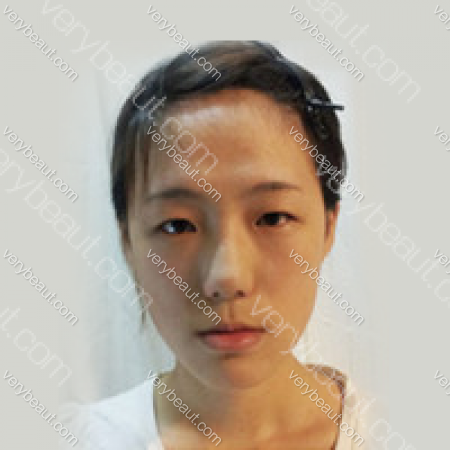 韩国原辰整形外科医院 拯救了我的”大长脸+地包天”—韩国原辰整形外科医院整形案例