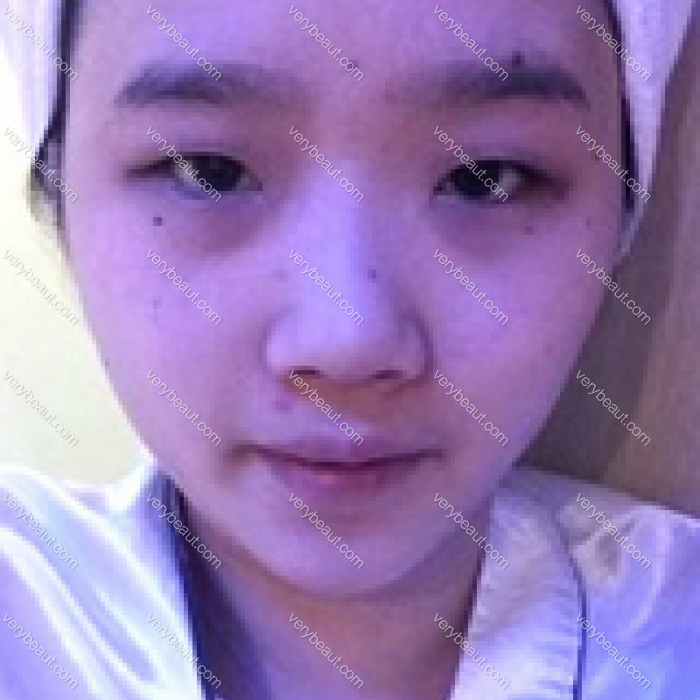 只做眼睛和鼻子 术后变化居然这么大—韩国格瑞丝整形外科整形案例