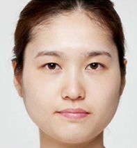 小眼单眼皮——S自然粘连双眼皮术打造电眼_韩国SY整形外科整形日记