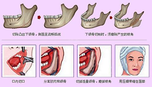 下颌角示意图