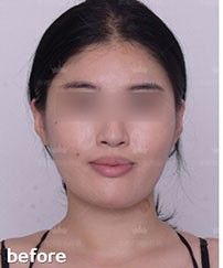分享一组上海伊莱美医疗美容整形医院 下颌角整形的案例_上海伊莱美医疗美容整形医院整形案例