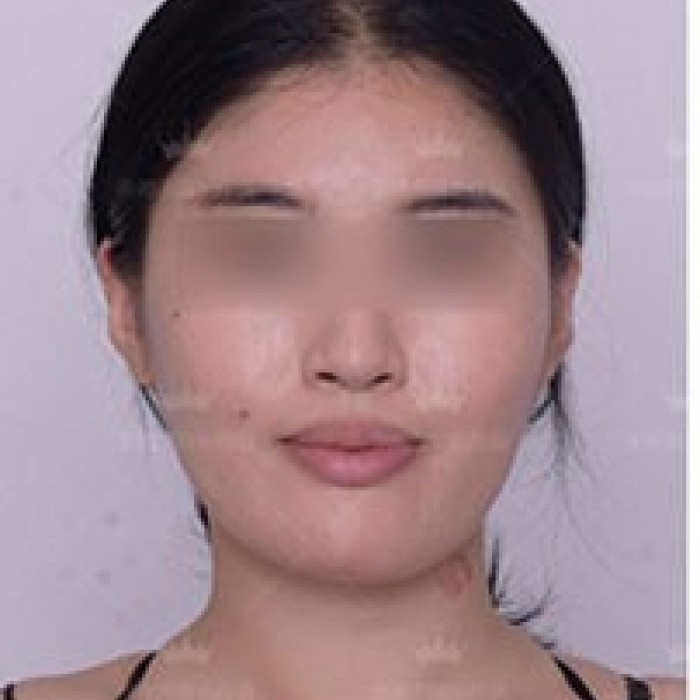 分享一组上海伊莱美医疗美容整形医院 下颌角整形的案例—上海伊莱美医疗美容整形医院整形案例