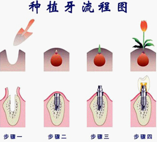 牙齿缺失修复做种植牙,不管是在稳固性,舒适性,功能性或是美观性上都