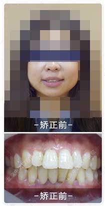 北京中诺口腔医院牙齿矫正前