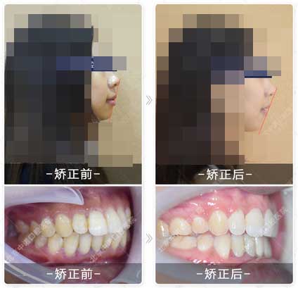 北京中诺口腔医院牙齿矫正案例对比