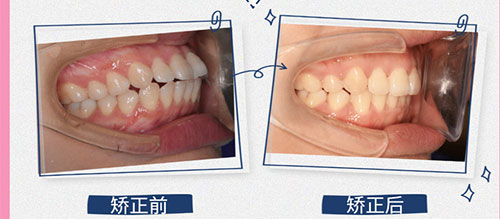 牙齿矫正术前术后对比图