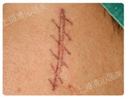 上海清沁医疗美容整形医院疤痕修复术前