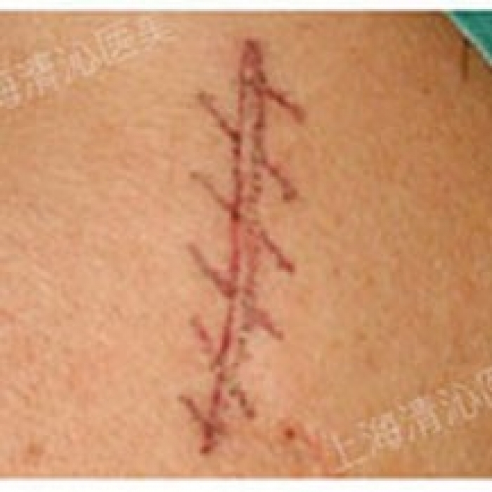 上海清沁医疗美容整形医院疤痕修复整形案例分享!—上海清沁医疗美容整形医院整形案例