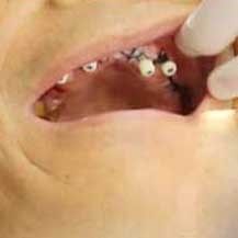 美奥口腔全口种植牙案例前后对比效果_上海美奥口腔门诊部整形案例