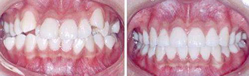 重庆牙博士口腔医院牙齿矫正案例对比