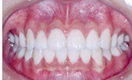 重庆牙博士口腔医院牙齿矫正案例术后