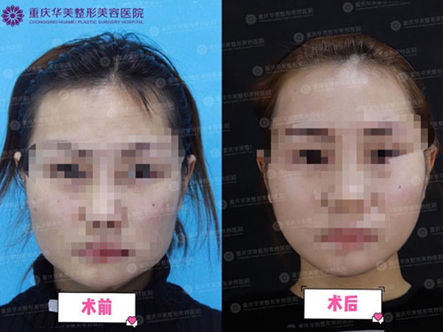 重庆华美美容整形医院改脸型案例对比