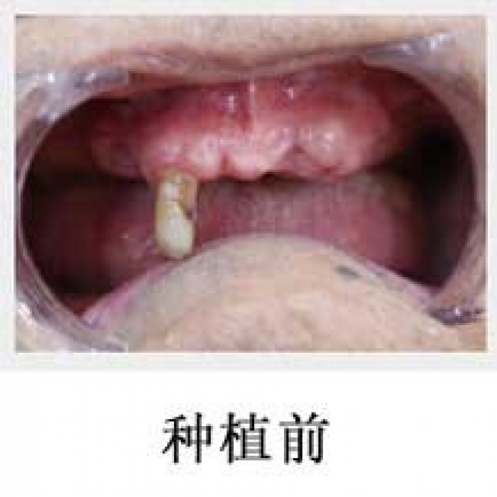 广州广大口腔医院即刻用种植牙真人对比实例公开