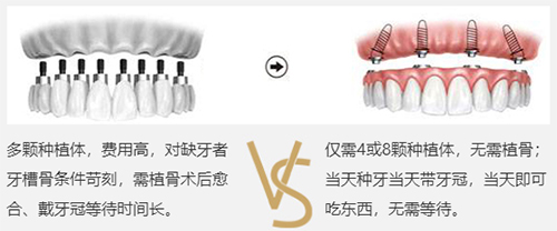 广州柏德口腔医院全口种植牙技术对比