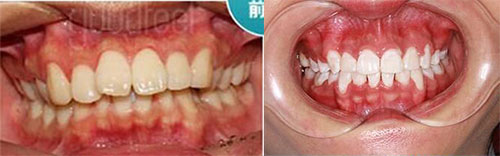 深圳格伦菲尔口腔医院龙华总院牙齿矫正对比
