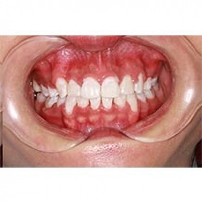 分享我在深圳格伦菲尔口腔做的牙齿矫正+冷光美白效果!—深圳格伦菲尔口腔医院整形日记