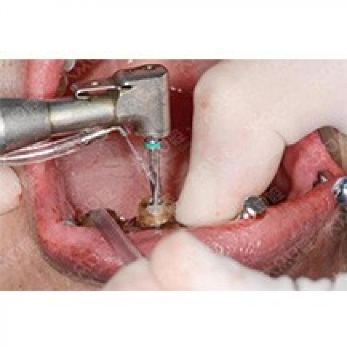 武汉大众口腔医院高难度种植牙案例展示—武汉大众口腔医院整形案例