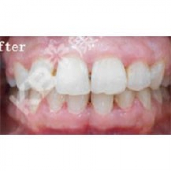 分享我在北京康贝佳口腔两颗种植牙的案例效果对比!—北京康贝佳口腔医院整形案例