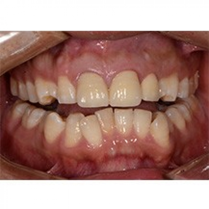 西安圣贝口腔医院牙齿修复案例对比—西安圣贝口腔医院整形案例