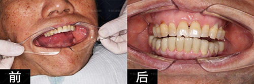西安中诺口腔医院立得用种植牙案例对比