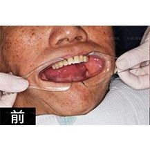 西安中诺口腔医院立得用种植牙真人案例_西安中诺口腔医院整形案例