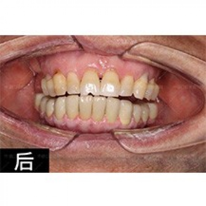 西安中诺口腔医院立得用种植牙真人案例—西安中诺口腔医院整形案例