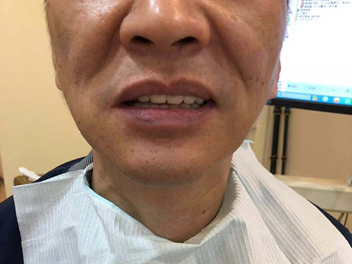 福州维乐口腔医院全口种植牙术后效果