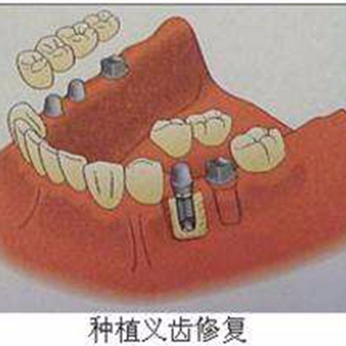 咸阳海涛口腔医院种植牙案例分享—咸阳海涛口腔医院整形案例