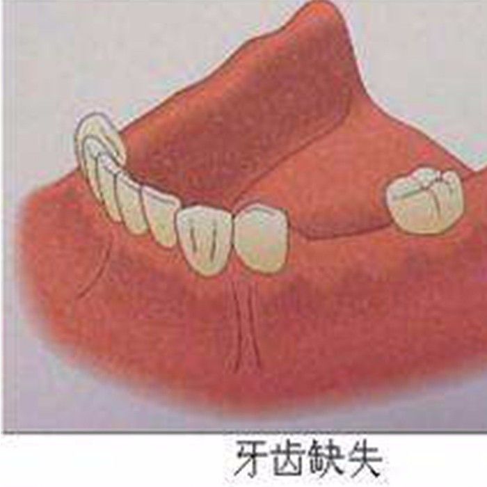 咸阳海涛口腔医院种植牙案例分享—咸阳海涛口腔医院整形案例