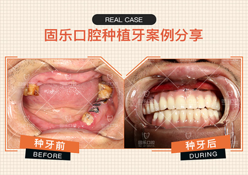 郑州固乐口腔医院全口种植牙案例