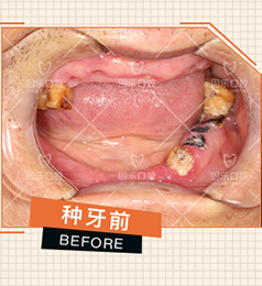 郑州固乐口腔医院全口种植牙案例手术前