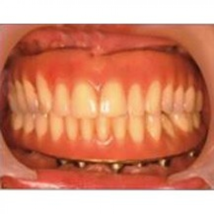 无锡维乐口腔全口缺失种植牙案例效果对比！—无锡维乐口腔门诊部整形案例