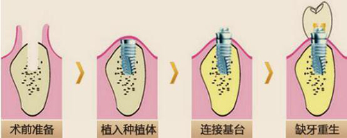 农村镶牙的过程图解图片