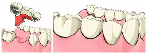 门牙镶牙过程图解图片