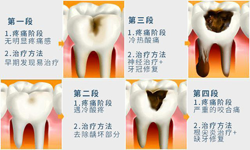 牙齿龋坏的几个阶段