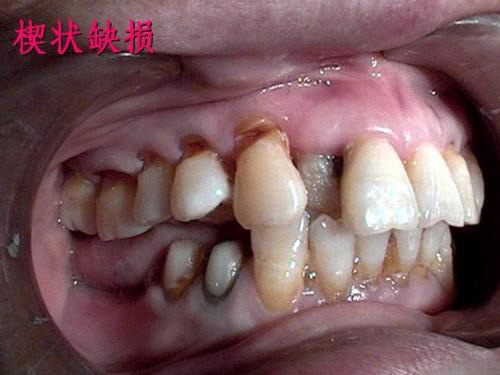 牙齿根部楔形缺损图片