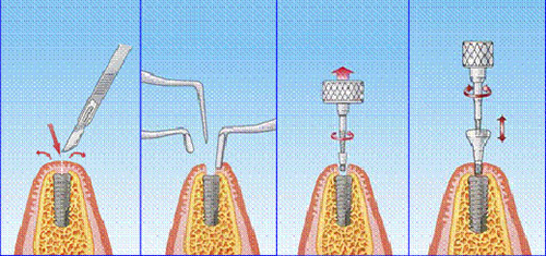 种植牙手术过程