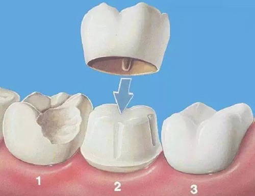 牙冠修复示意图