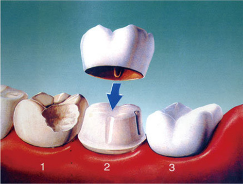 牙冠修复示意图