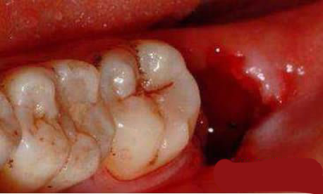 智齿伤口愈合过程图片图片