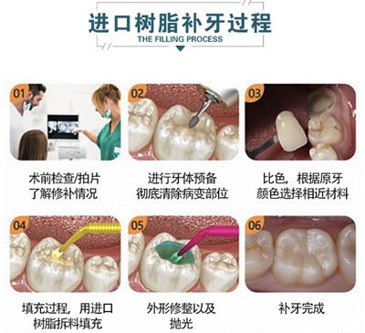 进口树脂补牙过程图