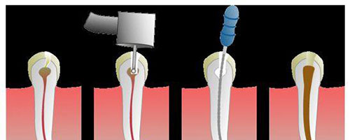 牙齿根管治疗示意图